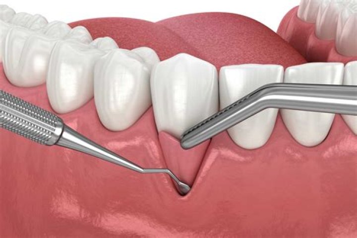 ¿Qué es la encia interdental