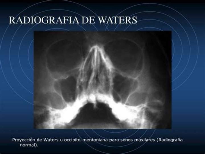 ¿Qué es la proyección de Waters