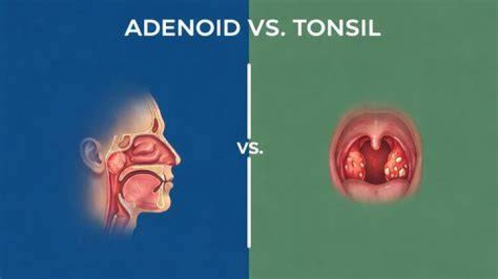 What are adenoids vs tonsils