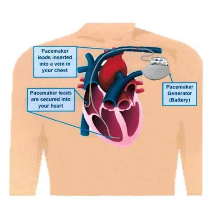 What are internal pacemakers