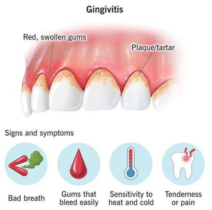What causes acute gingivitis