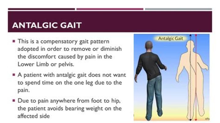 What causes Antalgic posture