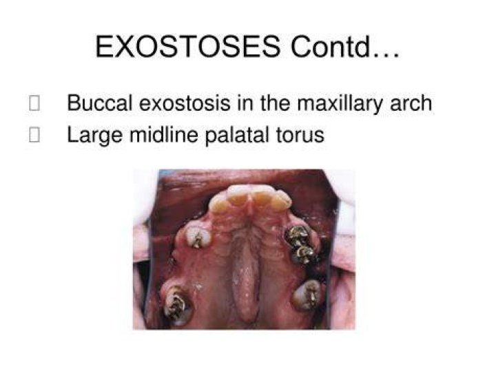 What causes buccal exostosis