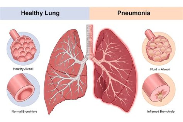 What causes double pneumonia