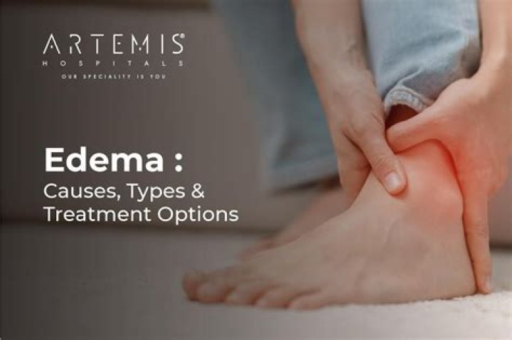 What causes epithelial edema