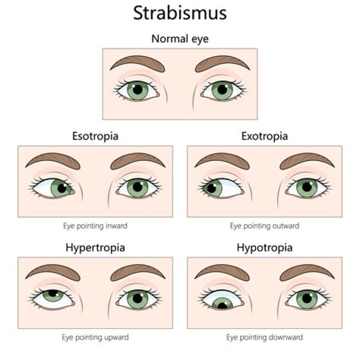 What causes eye misalignment