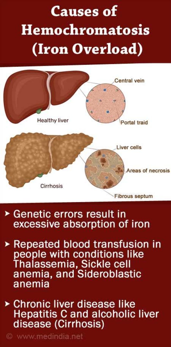 What causes high iron levels
