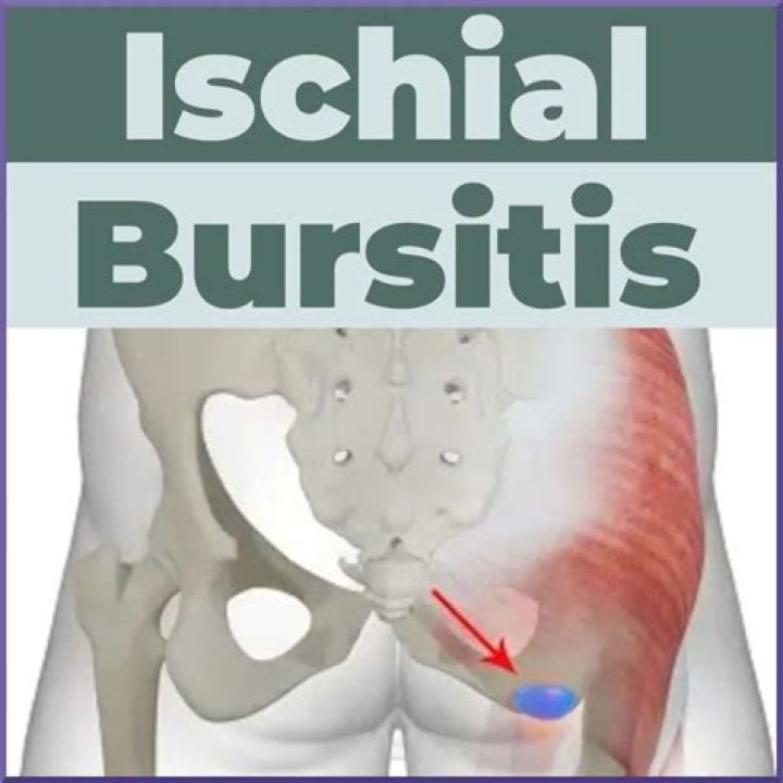 What causes ischial bursitis
