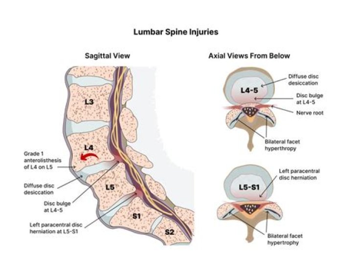 What causes limbus vertebra