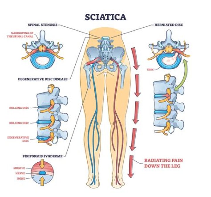 What causes lumbago sciatica