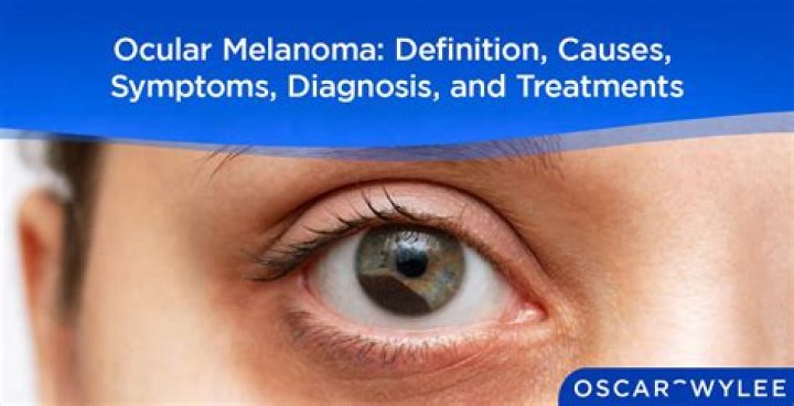 What causes ocular Melanosis