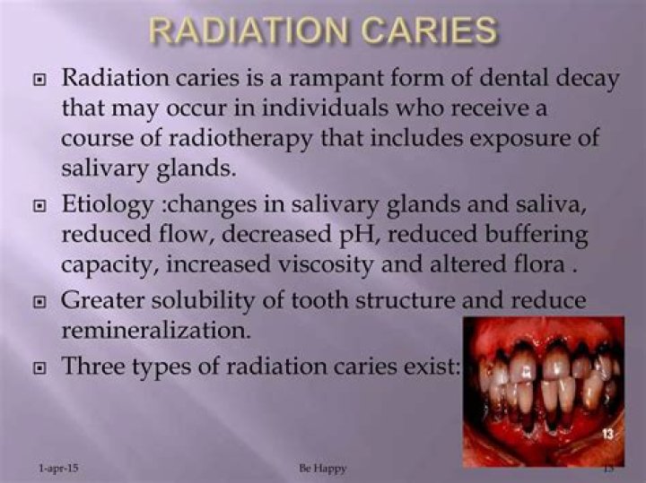 What causes radiation caries