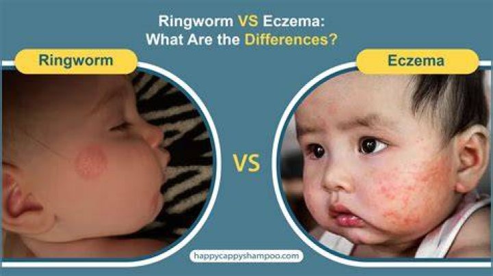 What causes ringworm in baby