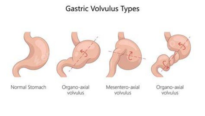 What causes stomach volvulus
