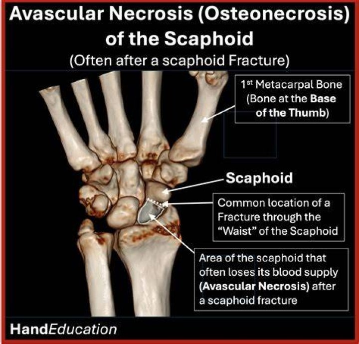 What causes tonsil necrosis