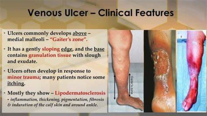 What causes vascular ulcers
