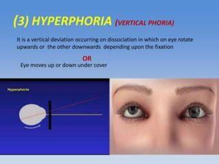 What causes vertical phoria