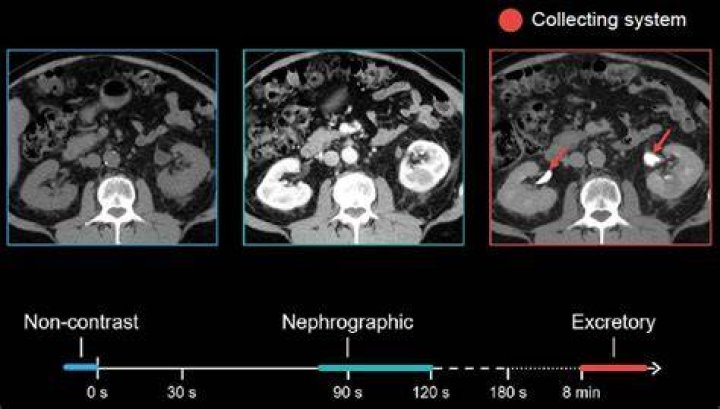 What does a CT Urogram show