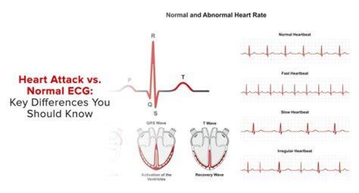 What does a normal ECG show