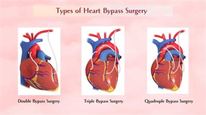 What does bypass pruner mean