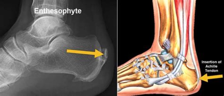 What does Enthesophytes mean