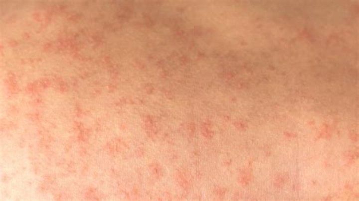 What does HFM rash look like