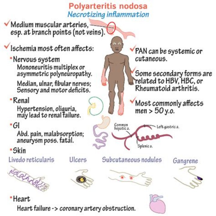 What does polyarteritis mean