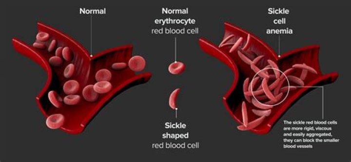 What does sickle cell effect