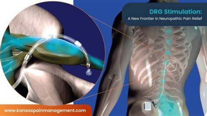 What DRG 392