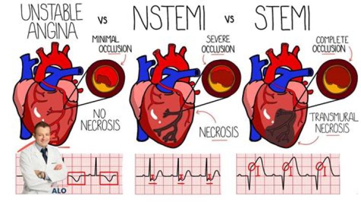What happens during a STEMI