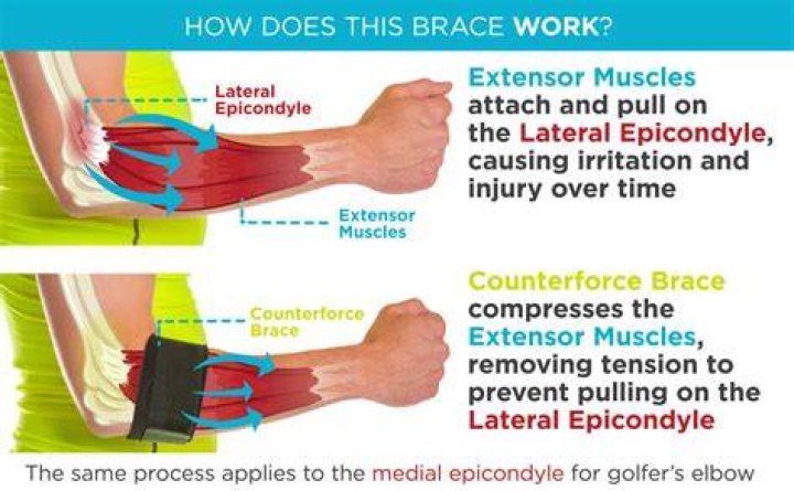 What is a counterforce brace