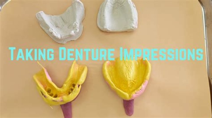What is a denture impression