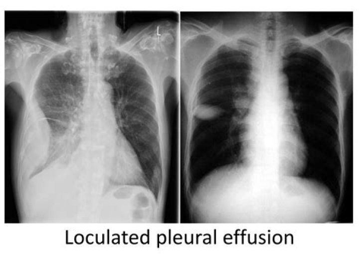 What is a loculated effusion