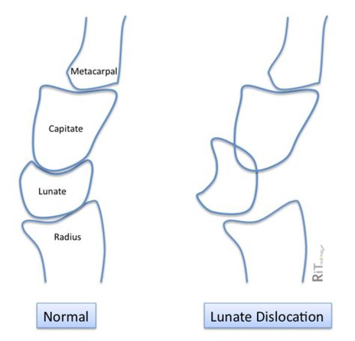 What is a lunate dislocation
