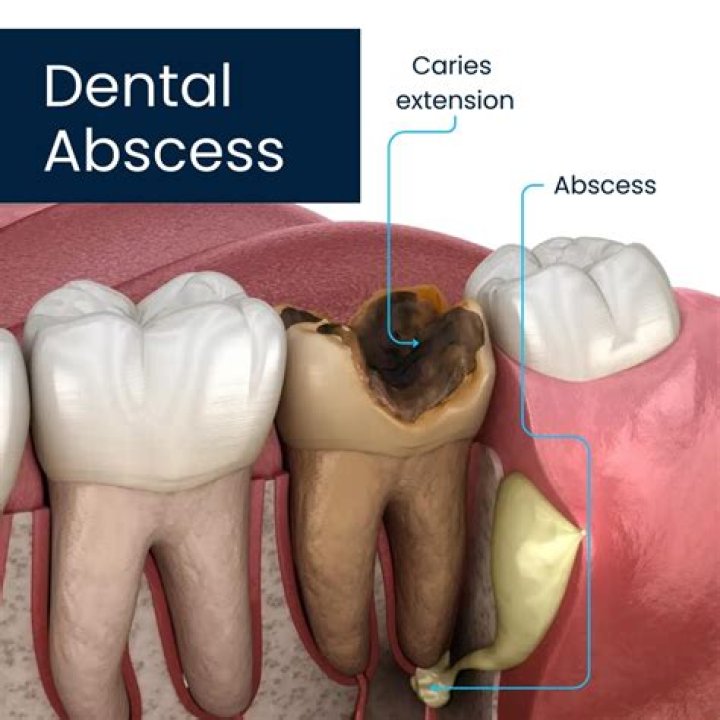 What is a mandibular abscess