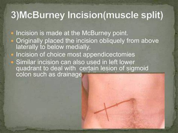 What is a McBurney incision