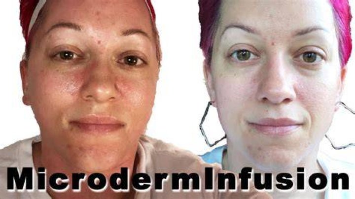 What is a Microderm infusion