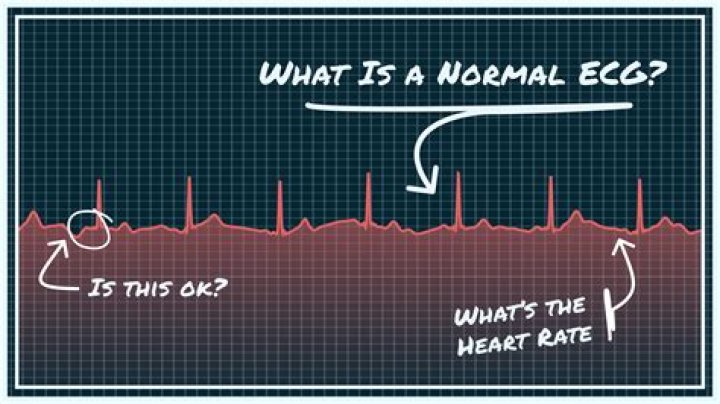 What is a normal ECG reading