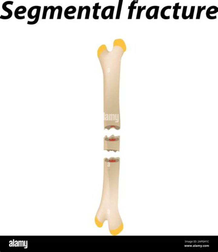 What is a segmental fracture