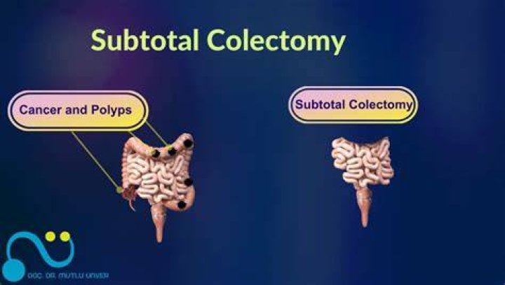 What is a subtotal colectomy