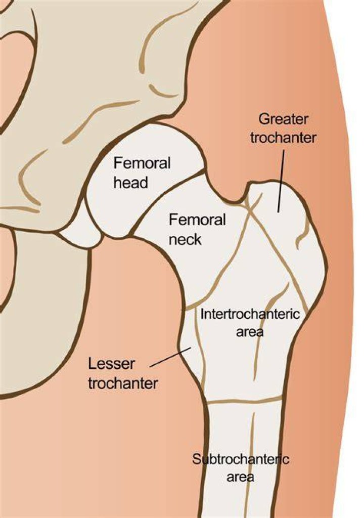 What is a trochanter support
