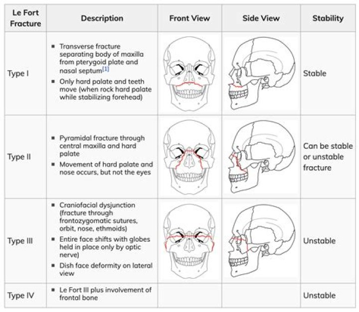 What is a Type III fracture