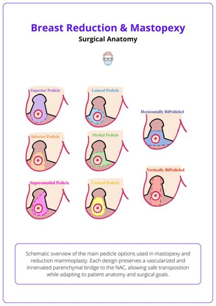 What is a vertical mastopexy