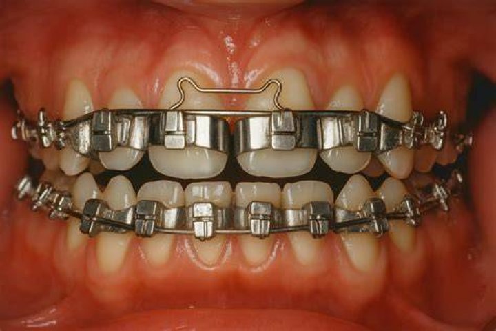 What is Allman style braces
