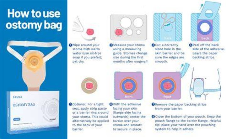 What is an ostomy baseplate
