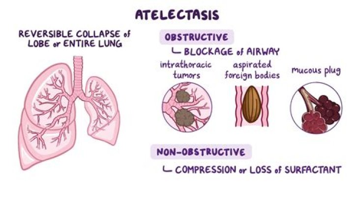 What is atelectasis scarring