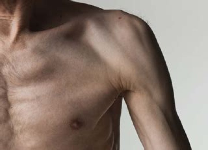 What is Cachectic appearance