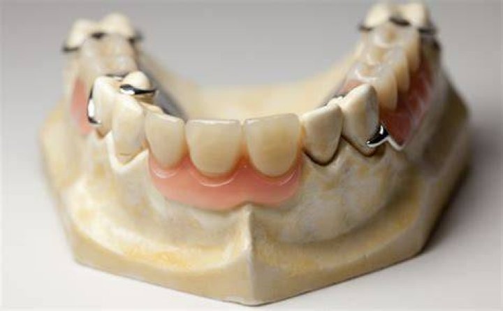 What is cast partial denture