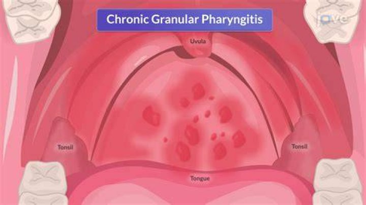 What is granular pharyngitis