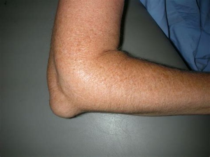 What is hemorrhagic bursitis